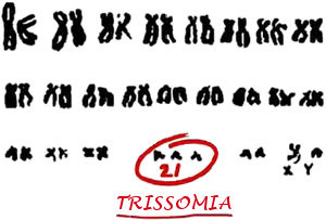 A trissomia, a marca do Síndrome de Down, ocorre quando um bebé nasce com três cópias do cromossoma 21, em vez duas, a situação habitual.